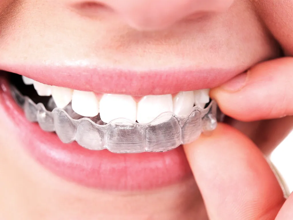 Invisible Aligners Busted