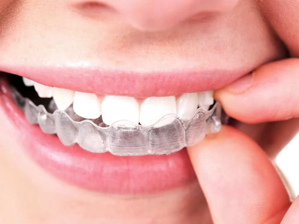 5 Common Myths about Invisible Aligners Busted!
